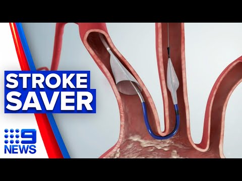 New device to reduce stroke risk in keyhole surgery | 9 News Australia