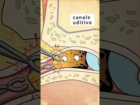 👂Cos'è quel grosso tappo di cerume nell'orecchio?❓#shorts#funny#hot