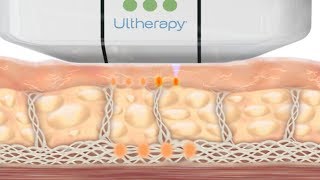 How the Ultherapy Treatment Works