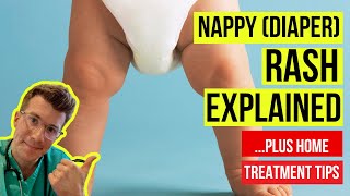 What  are SYMPTOMS OF NAPPY (DIAPER) RASH and HOW DO I TREAT it at home | Doctor O