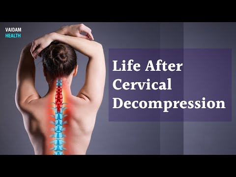 Life After Cervical Decompression
