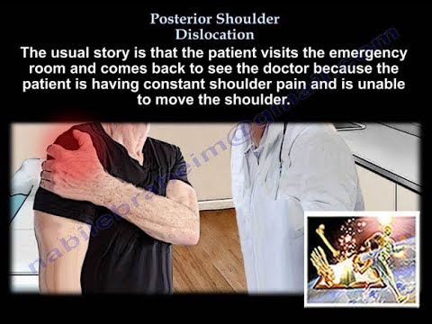 Shoulder Dislocation, posterior - Everything You Need To Know - Dr. Nabil Ebraheim