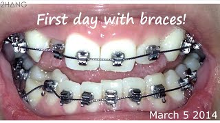 BRACES BEFORE AND AFTER TIME LAPSE