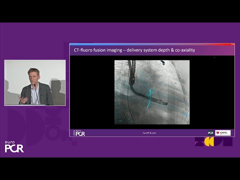 Transformative imaging in the clinical pathway of transcatheter tricuspid valve interventions