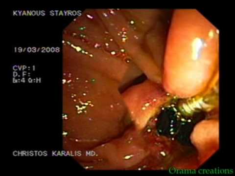 Gall Stones, ERCP