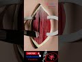 Tracheostomy Procedure 3D Animation