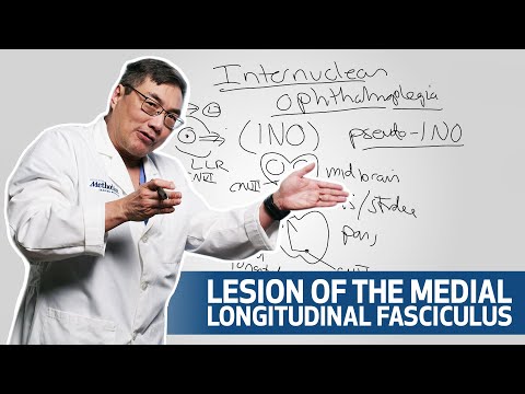 Evaluating Internuclear Ophthalmoplegia Houston Methodist