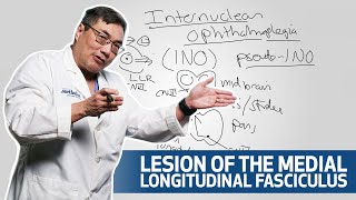Evaluating Internuclear Ophthalmoplegia | Houston Methodist