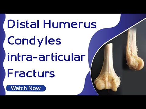 Distal Humerus Condyles intra-articular Fracturs | Orthopaedic Academy