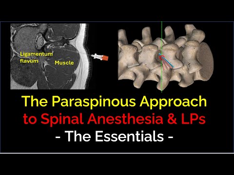 Paraspinous Spinal Anesthesia & LPs - Essential Principles for Success