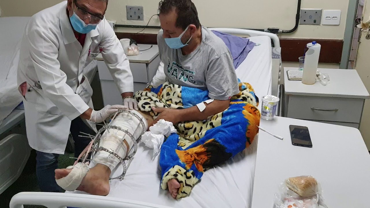 Fisioterapia no pós operatório de paciente em uso de Fixador Ilizarov