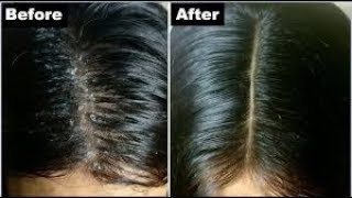 HOW TO STOP DRY ITCHY SCALP & FLAKING