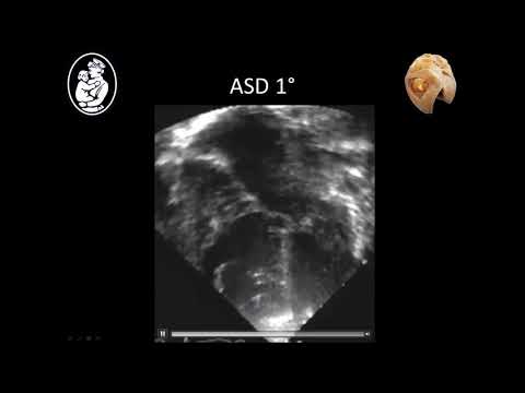 Atrioventricular canal defects - Stephen Sanders, MD