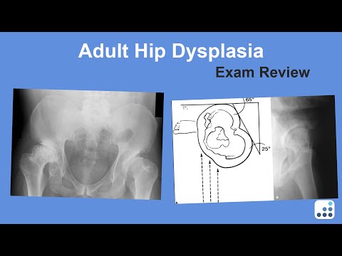 Adult Hip Dysplasia Exam Review - William Jiranek, MD
