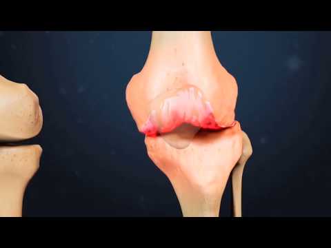 afectarea articulațiilor în bolile infecțioase cum să tratezi sinovita genunchiului