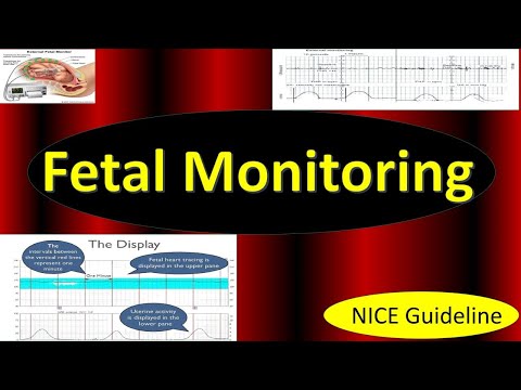 Fetal Monitoring in Labor, NICE Guideline (2022) / Updates in Cardiotocography, CTG