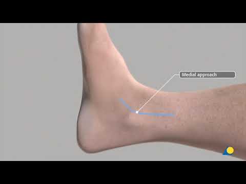 AO Tibia and Fibula - Malleolar Fracture ORIF