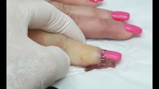 Worst Nail Infections of All Time!  Paronychia