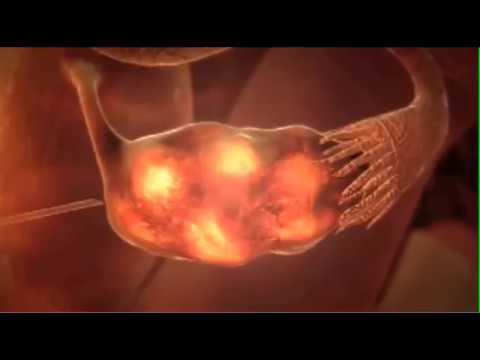 What is IVF - Process of In vitro fertilization