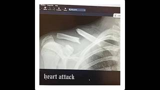 Cover art for heart attack demo