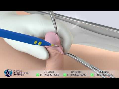 Aumentare membro Filer Tutto sul trattamento di impotenza