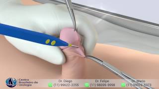 Frenuloplastia - Dr. Diego Delgado