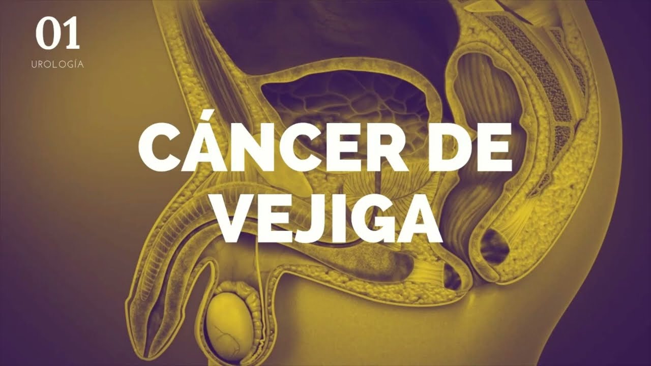 Cáncer de vejiga - ENARM