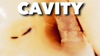 $2500 ROOT CANAL/CROWN vs $150 CAVITY FILLING MISTAKE!