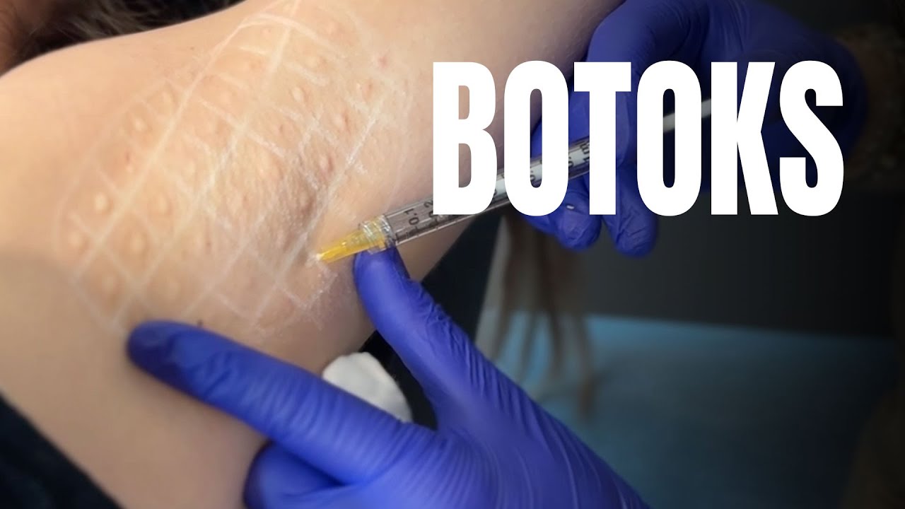 KOLTUK ALTI TERLEME VE TÜM YÜZ BOTOKSU