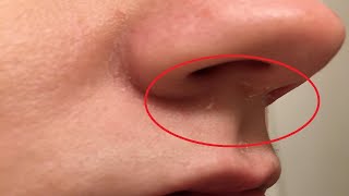 how to get rid of dry skin on nose after cold