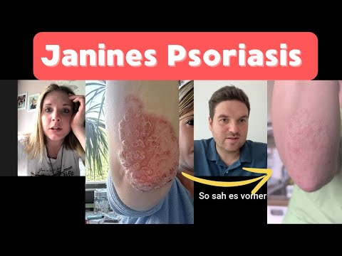 SCHUPPENFLECHTE fast weg! Natürlich geheilt - Interview mit Janine