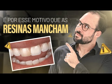 Como fazer acabamento e polimento perfeitos na resina composta