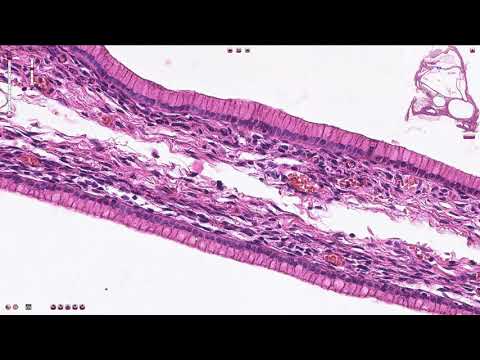 malignant pleural mesothelioma with surgery