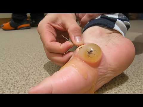 he found a SPIDER under his skin...