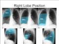 CXR - How to read the chest x ray - Part I: Concepts and Quality