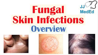 Overview of Fungal Skin Infections | Tinea Infections