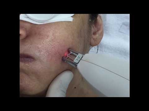 Facial thread veins treatment with FormaTK's 1064nm Nd logo