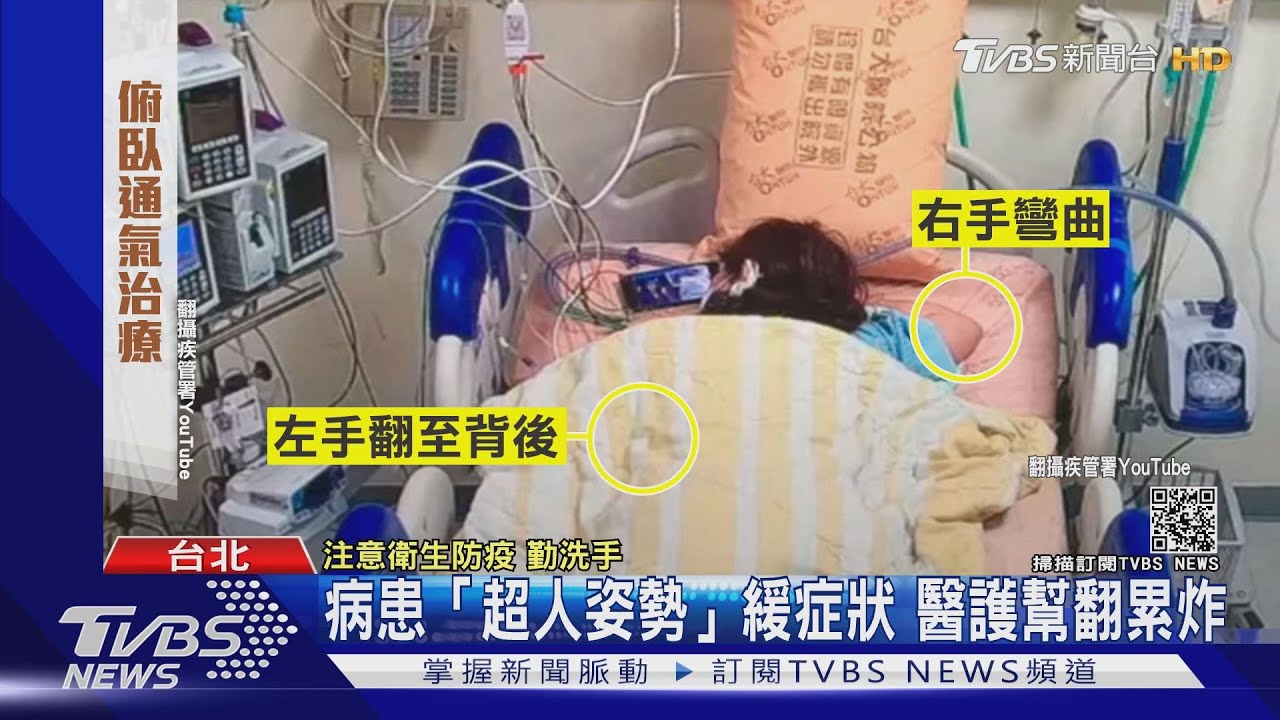 俯臥通氣治療!病患「超人姿勢」緩症狀 醫護幫翻累炸