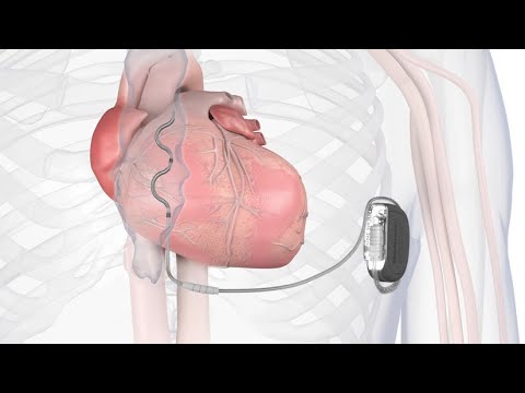 What is the Aurora EV-ICD™ system?