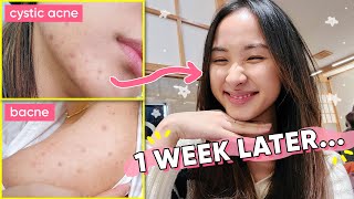 ~1 THING~ that healed & reset my hormonal acne, NATURALLY | Acne Series