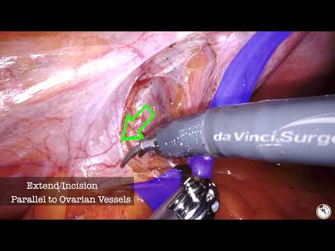 Robotically Assisted Retroperitoneal Entry and Ureterolysis