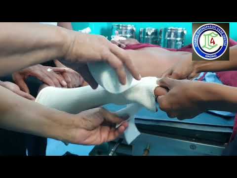 Fracture Lower end Radius | Closed reduction under Short GA & Plastering | Adamya Hospital videos
