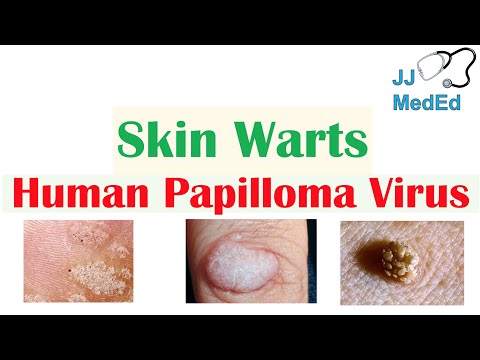 Overview of Skin Warts (Verrucae) | What Causes Them? Who Gets Them? | Subtypes and Treatment