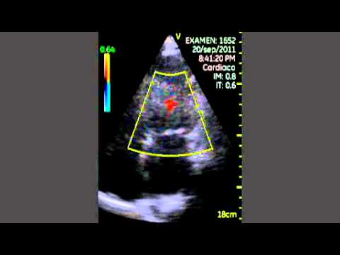 Cardiac Amyloidosis - Pocket Ultrasound