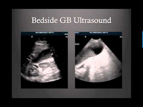 Gallbladder Ultrasound Case Based MS3 Video