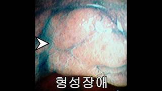 위암과 장상피화생