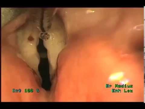 Vocal Cord Polyps Removal Using Laser