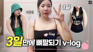 [팔뚝 지방흡입] 3일만에 슬림팔뚝 #변상국원장