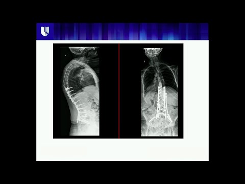 Outcomes of Adult Deformity Surgery - Christopher I. Shaffrey, MD