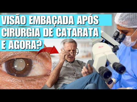 VISÃO EMBAÇADA APÓS CIRURGIA DE CATARATA. E AGORA?